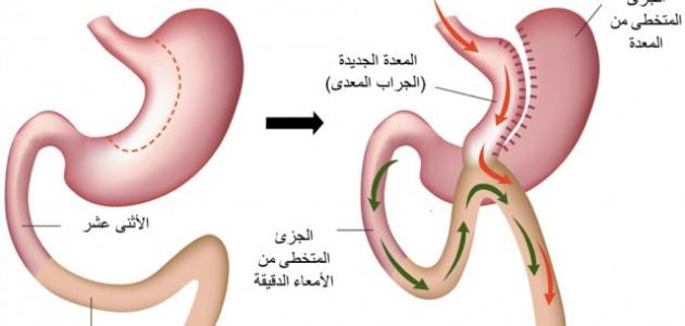 حياتي بعد عملية تحويل مسار المعدة 686