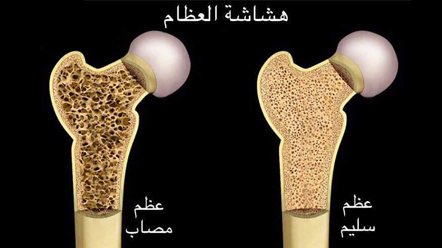 كيف تبني عظامك - لازم تحافظ على حياتك