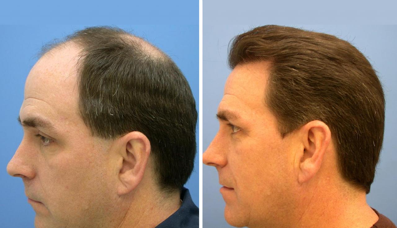 زراعة الشعر للرجال- حل برده ممكن ينفع 1483